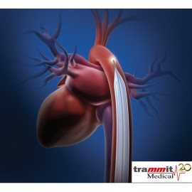 Cateter para Terapia de balão intra-aórtico