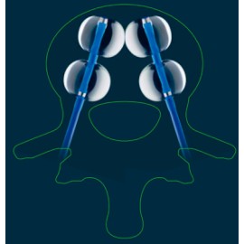 Balão de Cifoplastia Kyphon